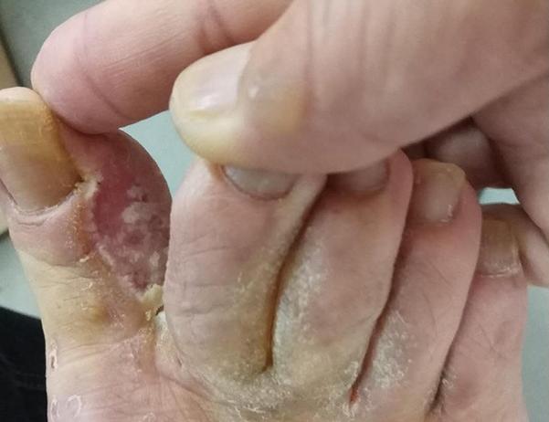 日本人如何处理脚气问题,欧美人为什么更容易患脚气