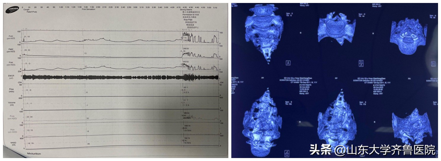 儿童微创手术全麻,儿童局灶性癫痫电极植入