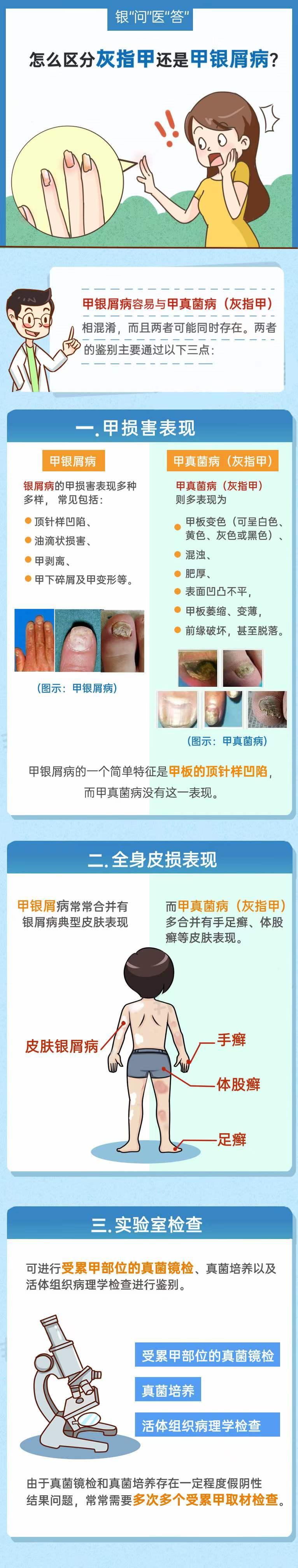 灰指甲与银屑病区别,灰指甲与甲癣