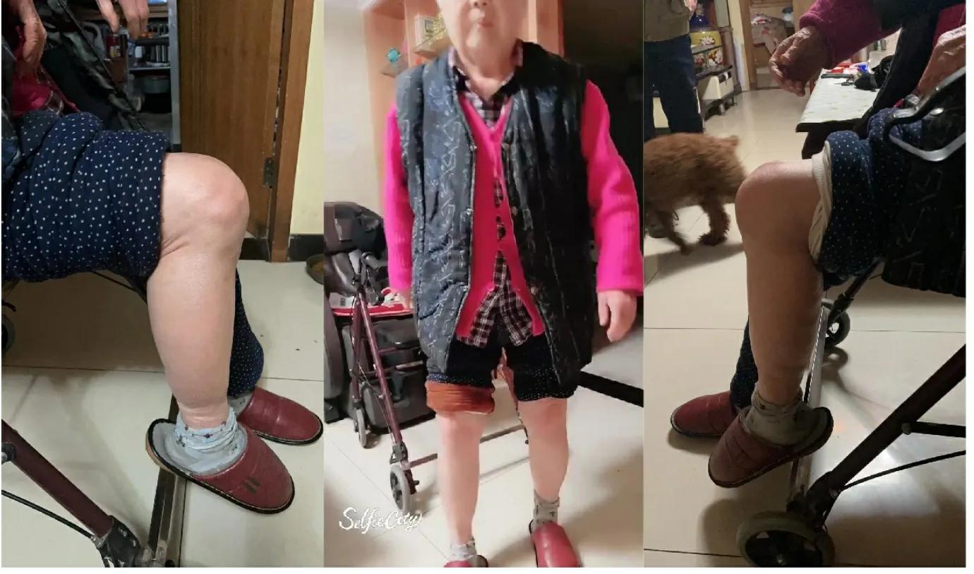 双膝重度骨性关节炎诊疗一例---匠琢骨科