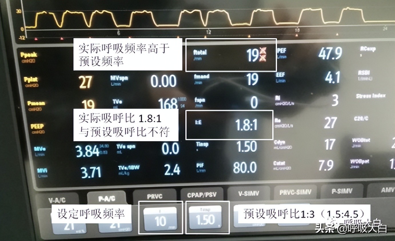 呼吸机设置：呼吸频率+吸呼比
