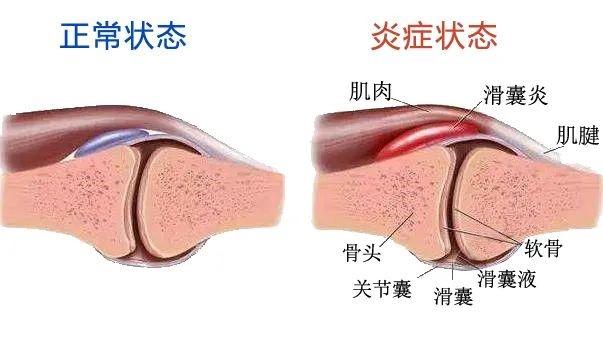 一文读懂什么是肌筋膜炎,一文读懂膝关节