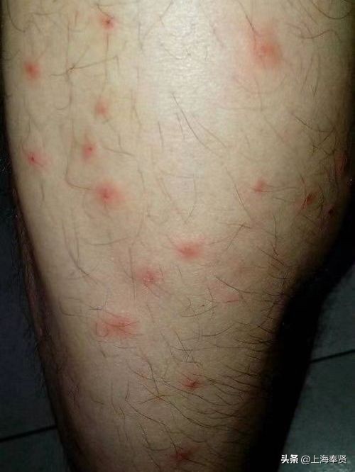 夏季被虫子咬了怎么办,夏季皮肤病攻略虫咬感染篇