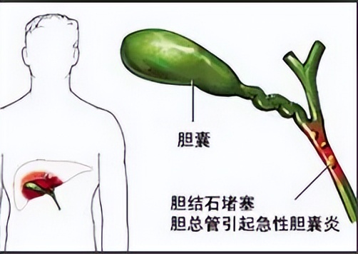 口干口苦耳鸣的中成药方,清肝明目口苦耳鸣用啥泡着喝好