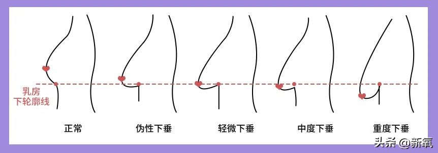 胸部明显大小不一怎么办,胸部越来越小是病理吗