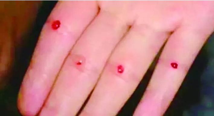 小儿疳积最快最好方法,小儿疳积最快治愈方法