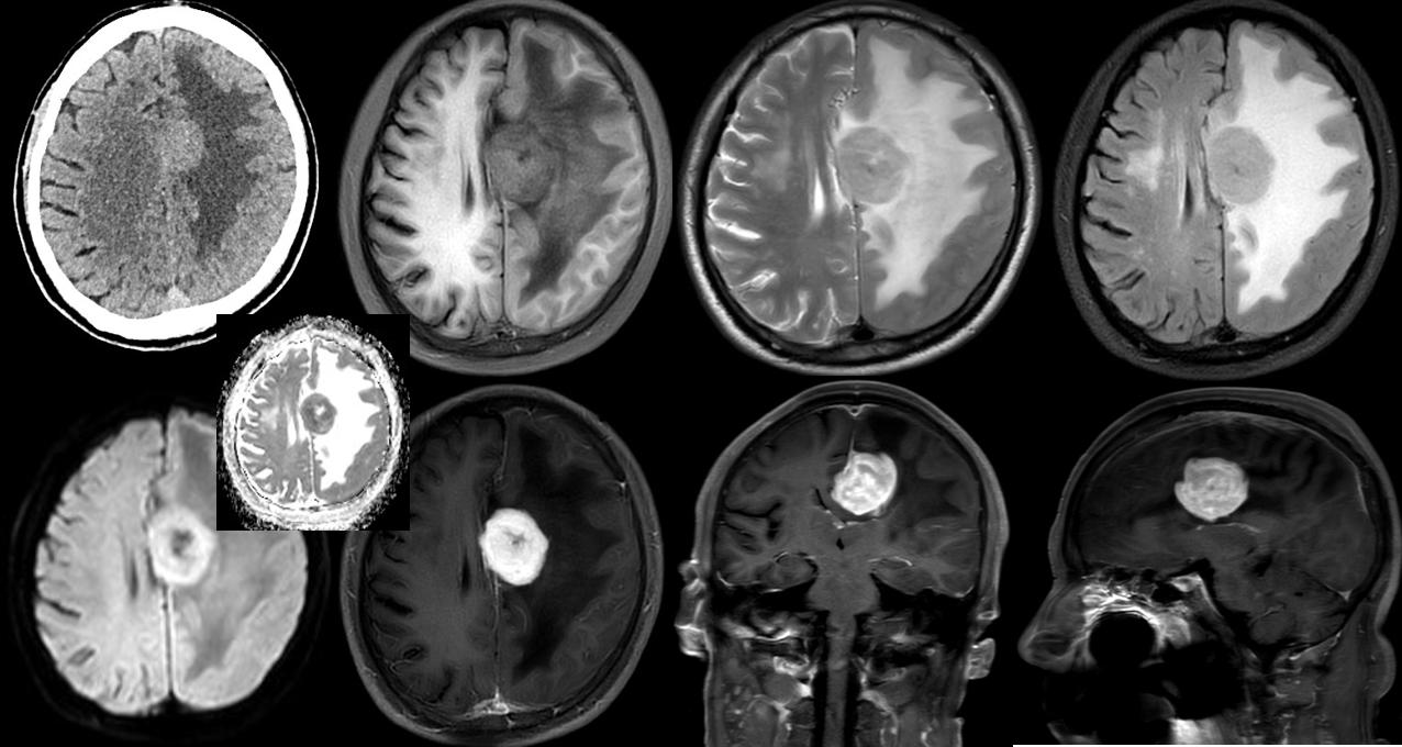 骨软骨瘤mri,颅骨血管瘤mri表现