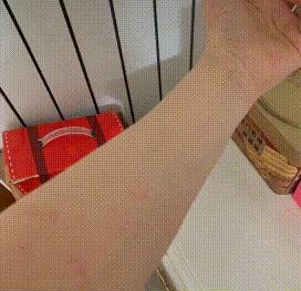 麻疹有什么忌口,麻疹饮食要注意一百天吗