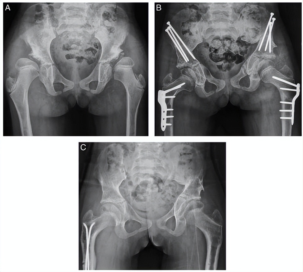 北京积水潭医院脊柱微创视频,北京积水潭医院矫形骨外科