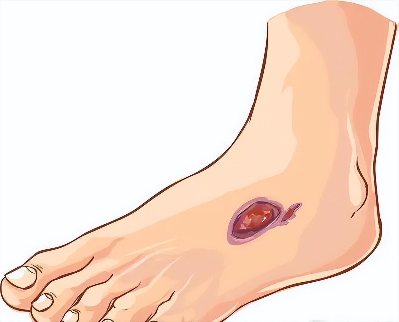 怎样治疗糖尿病足部溃疡,糖尿病人足部溃烂怎么办