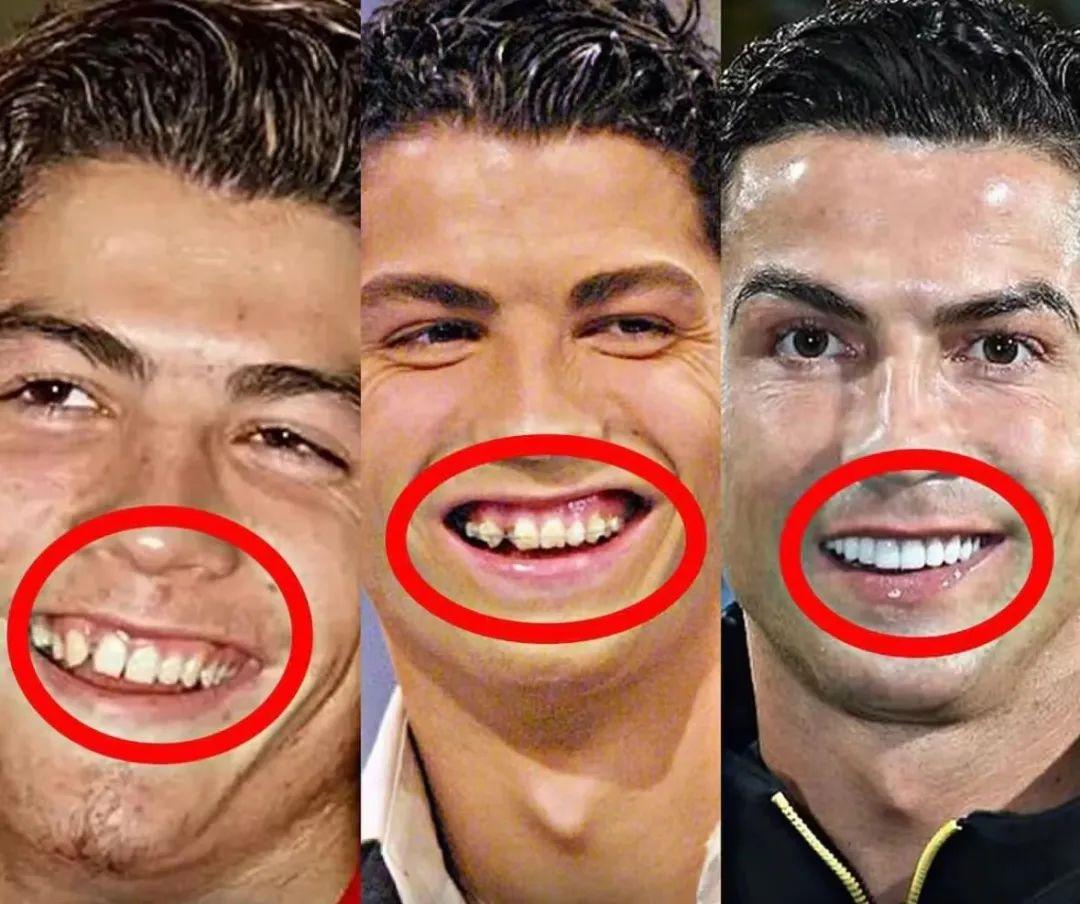c罗是怎么整牙的,c罗的牙齿整过形吗
