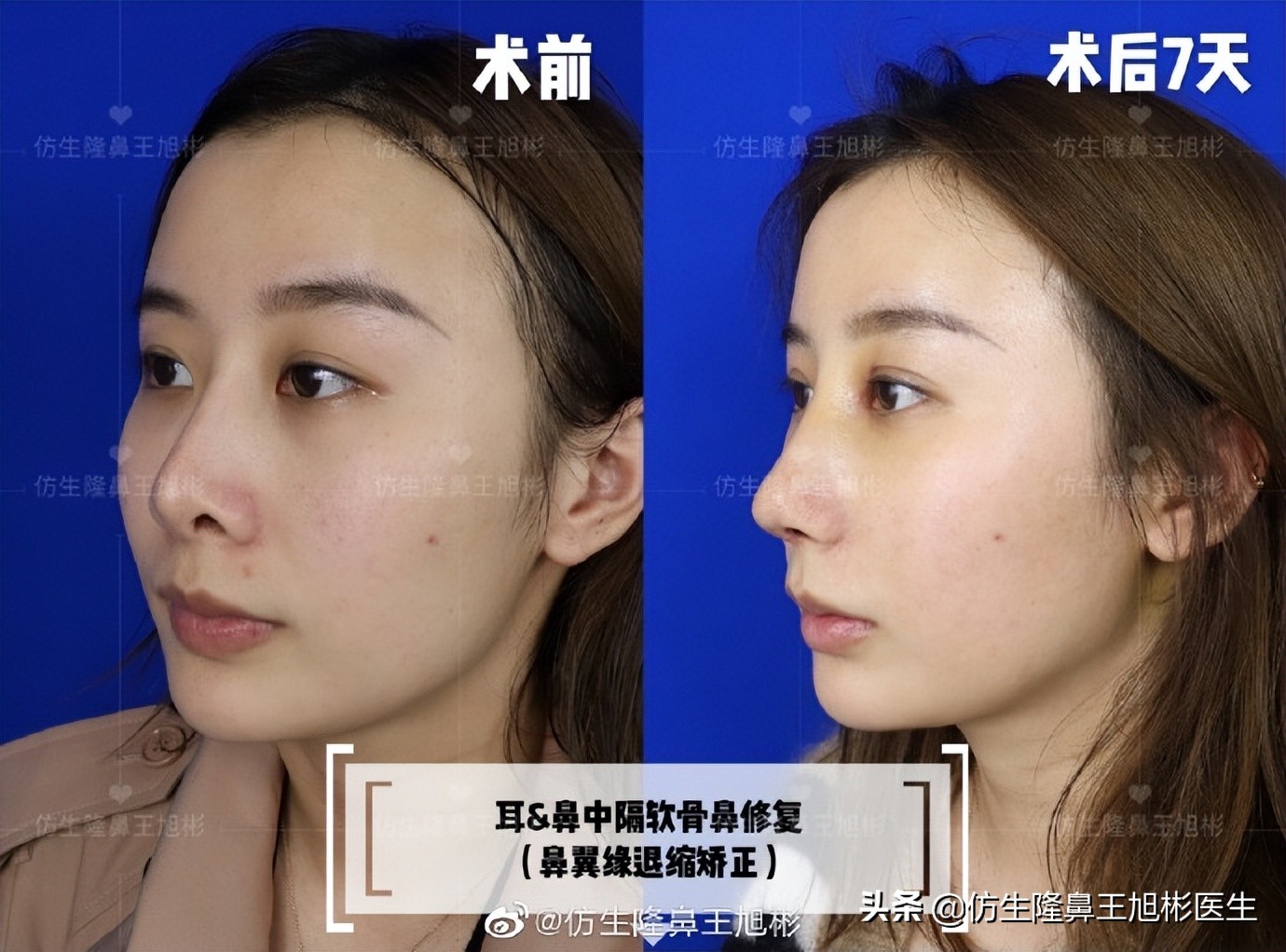 假体隆鼻耳软骨垫鼻尖图片,l型假体耳软骨隆鼻图片