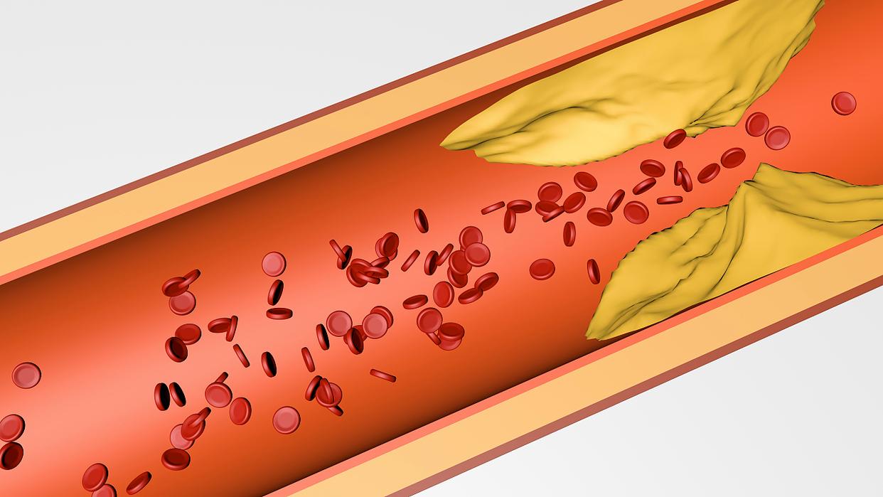 老年人预防脑梗补充叶酸每天剂量,叶酸能清除斑块预防脑梗吗