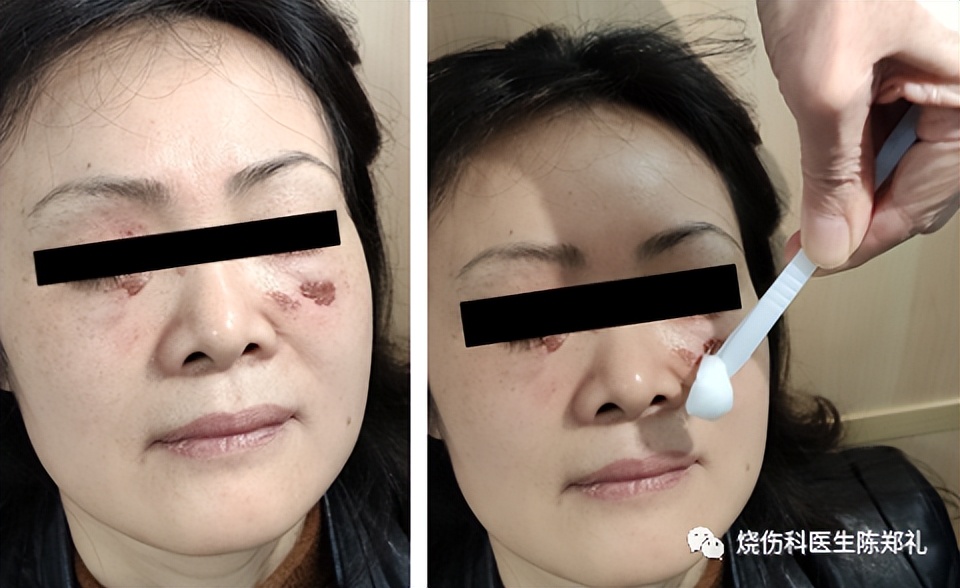 小孩不听话进厨房被烫伤,小朋友被油锅烫伤怎么办