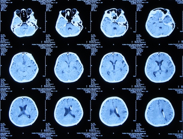 结核脑炎型脑积水怎么治,结核性脑膜炎2期很严重吗