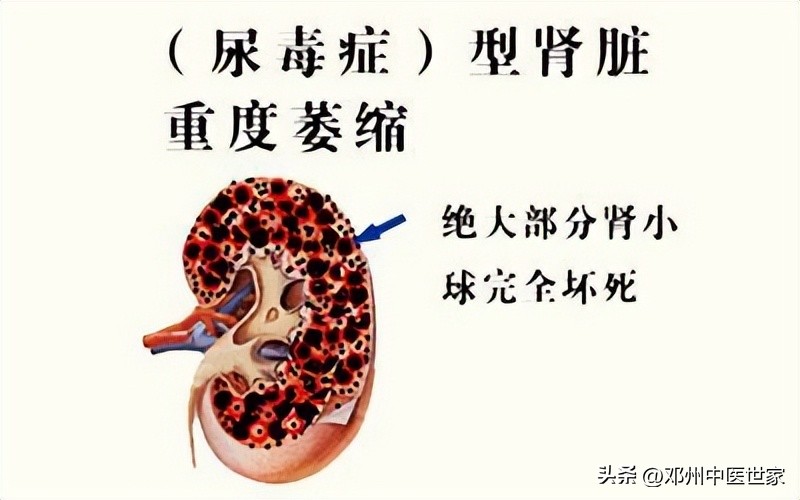 尿毒症治愈病例,中医治尿毒症医案