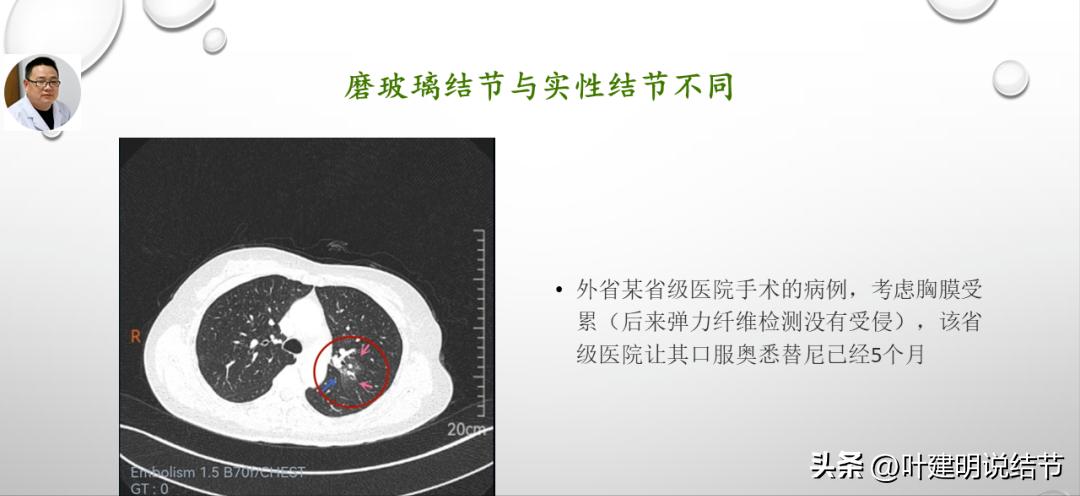 非小细胞肺癌精准检测ppt,关于肺癌的ppt