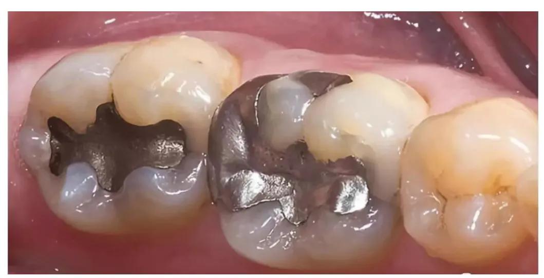 牙齿历险记（第12集）补牙材料