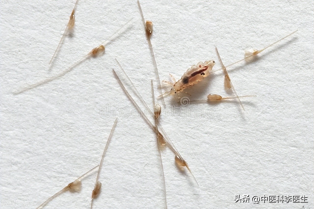 下体瘙痒发现两三只阴虱严重吗,阴部有几十只阴虱