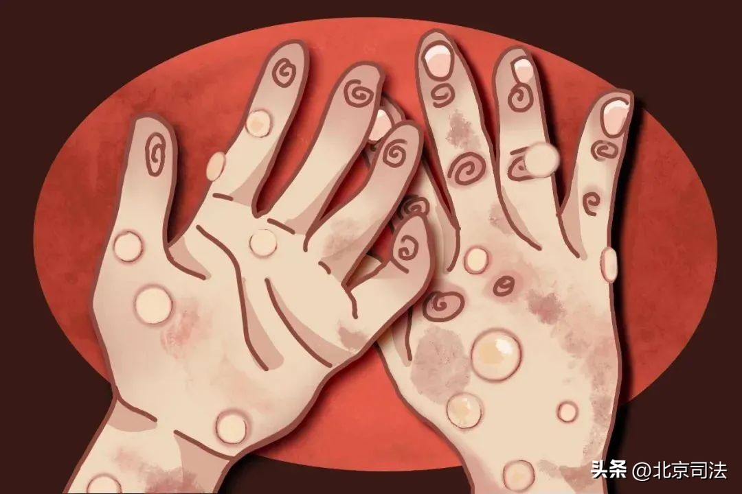 猴痘突发值得担心吗,猴痘应急预案和流程