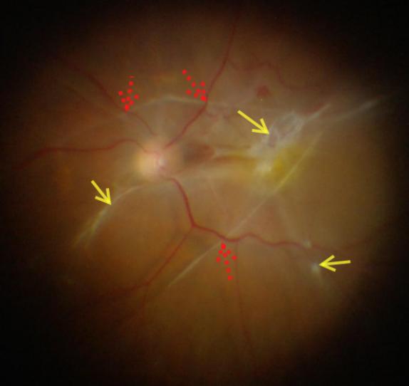 视网膜脱落复位手术,增生性玻璃体视网膜病变的表现