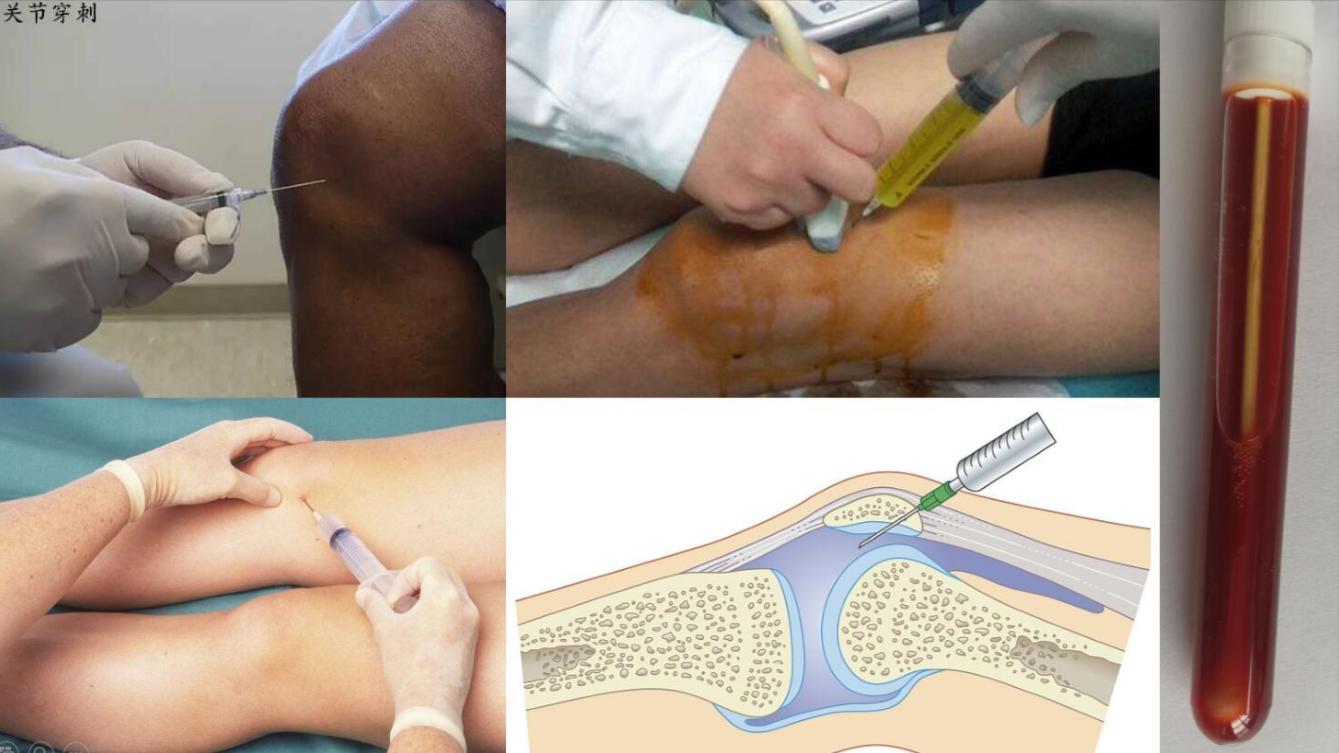 滑膜炎怎么恢复注意什么,滑膜炎怎样治疗才能快速恢复