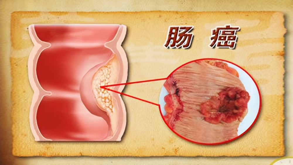 肛周瘙痒是不是痔疮引起的,肛周瘙痒会引发痔疮吗