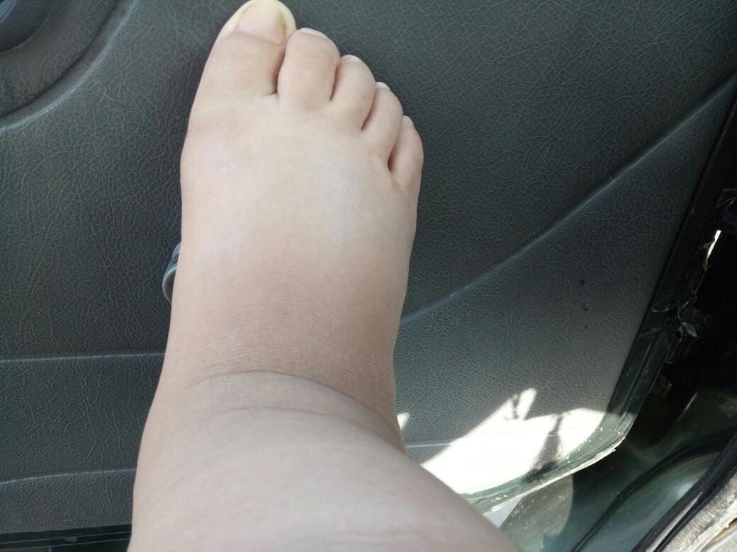 舌中凹陷有裂纹怎么回事,舌中部凹陷裂纹中医代表什么