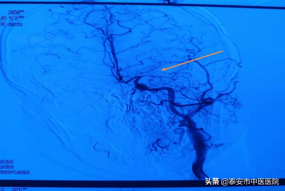 硬核技术!*安泰**市中医医院成功完成本院首例颅内外血管搭桥手术