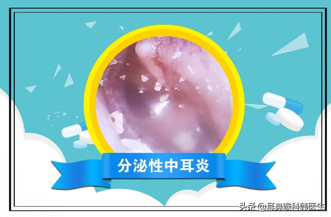 耳鼻喉电子内窥镜能检查哪些问题,硬性耳内窥镜检查疼吗