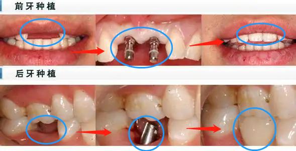 老年人牙齿松动会自动掉吗,老年人洗牙更容易牙齿松动吗