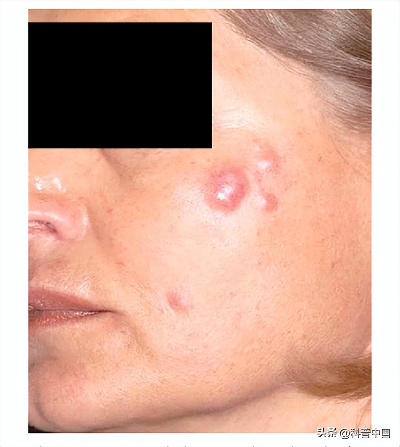 女子打水光针毁容了,打水光针毁容真实视频