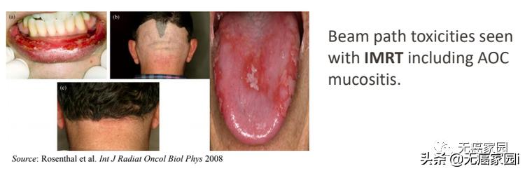 头等大事严防严控,硼中子俘获疗法能彻底治愈癌症吗