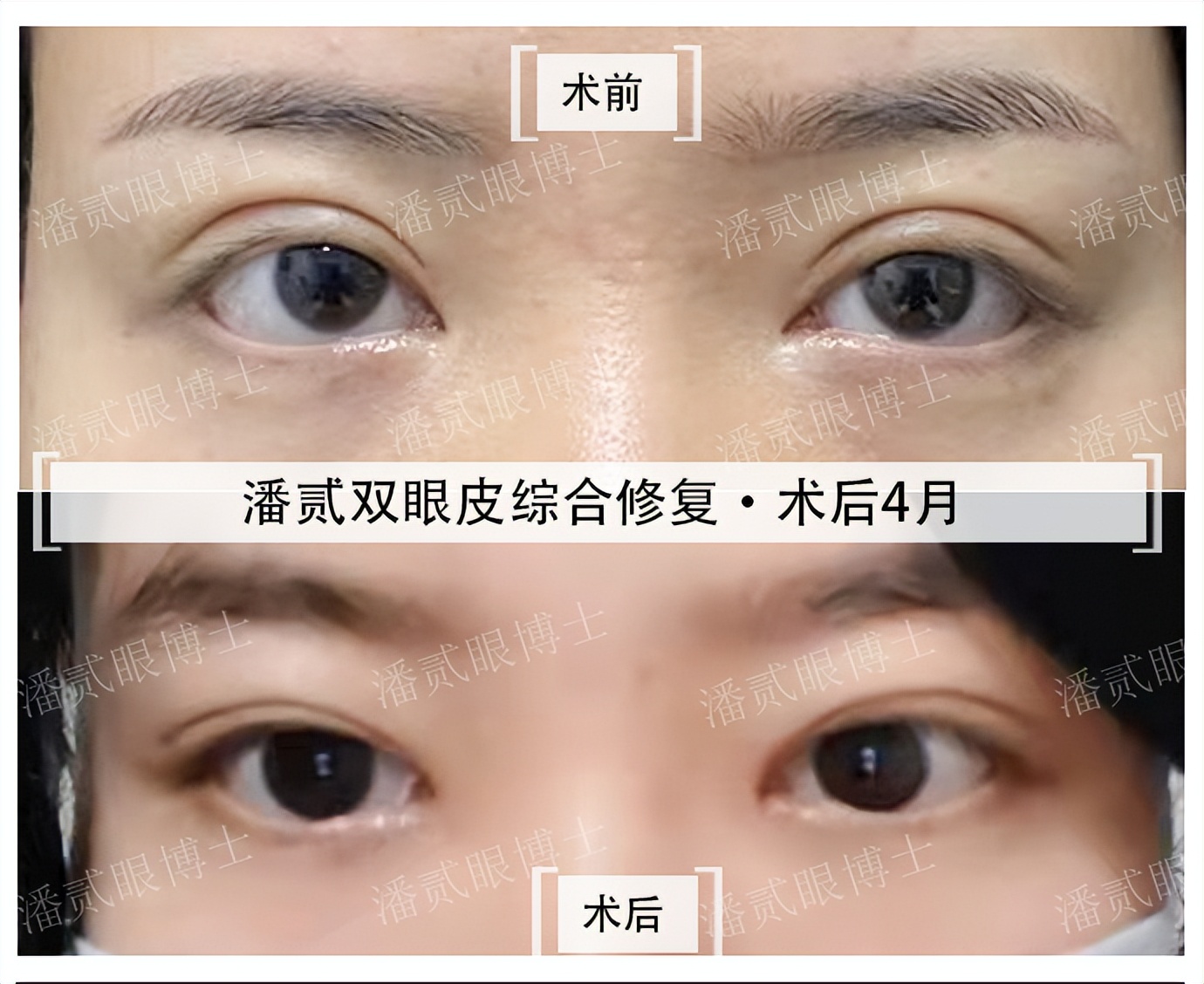 整容后眼睛不能闭合,整容失败眼睛无法闭合