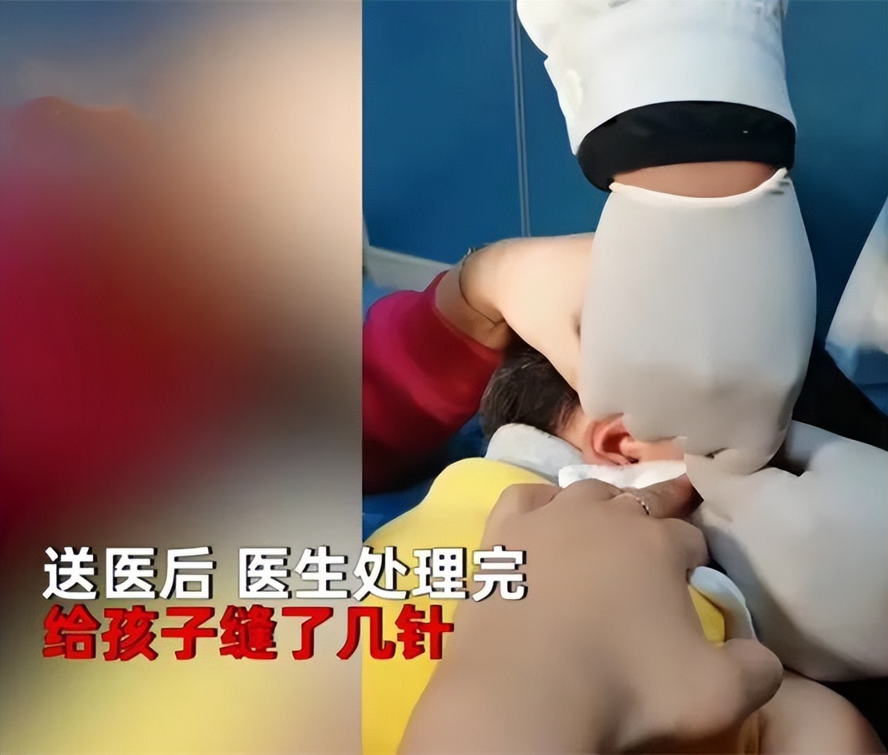 妈妈帮孩子理发发现蜱虫,小孩儿头上发现有蜱虫