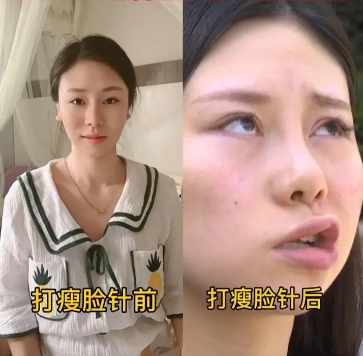 29岁姑娘打瘦脸针后就面瘫后续,姑娘打瘦脸针导致面瘫