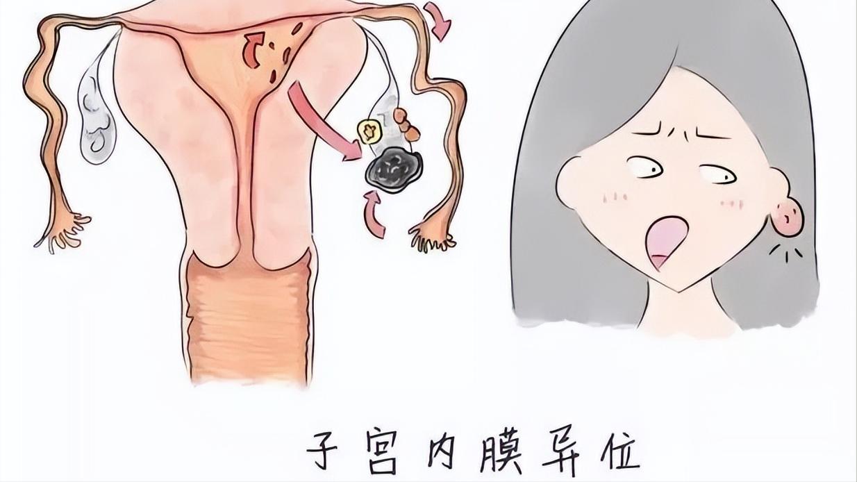 女性没了子宫之后和正常人有什么区别？身体的变化，让你无法忽视