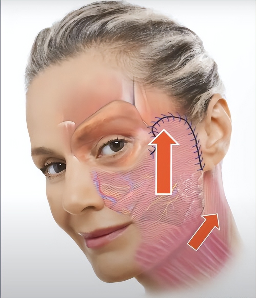 做个面部拉皮手术要多少钱啊,拉皮手术多长时间能全部消肿