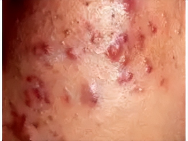 痘痘肌肤怎么形成的,痘痘肌肤问题及解决方法