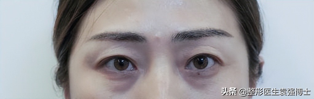眼周年轻化手术效果可以持续多久,眼周医美项目