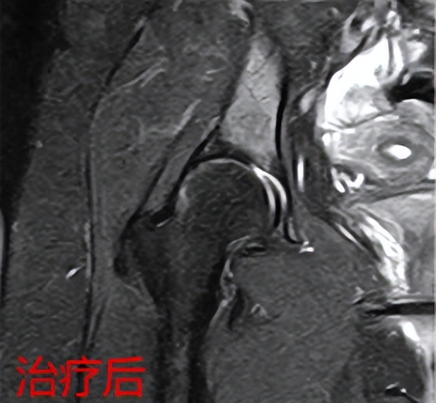 骨冲击波治疗仪,治骨疼痛最特效药方