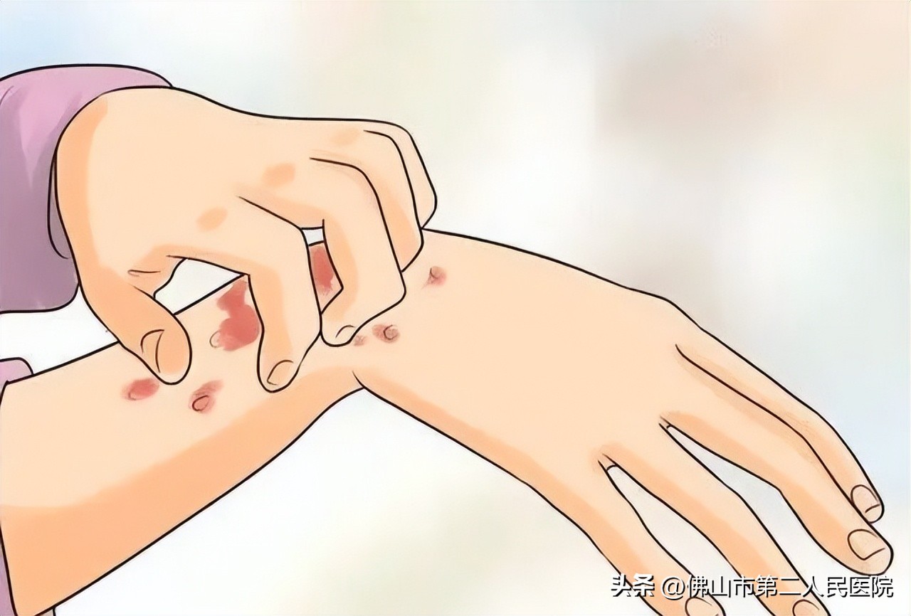 春季易发哪些皮肤病,秋冬常见皮肤病有哪些