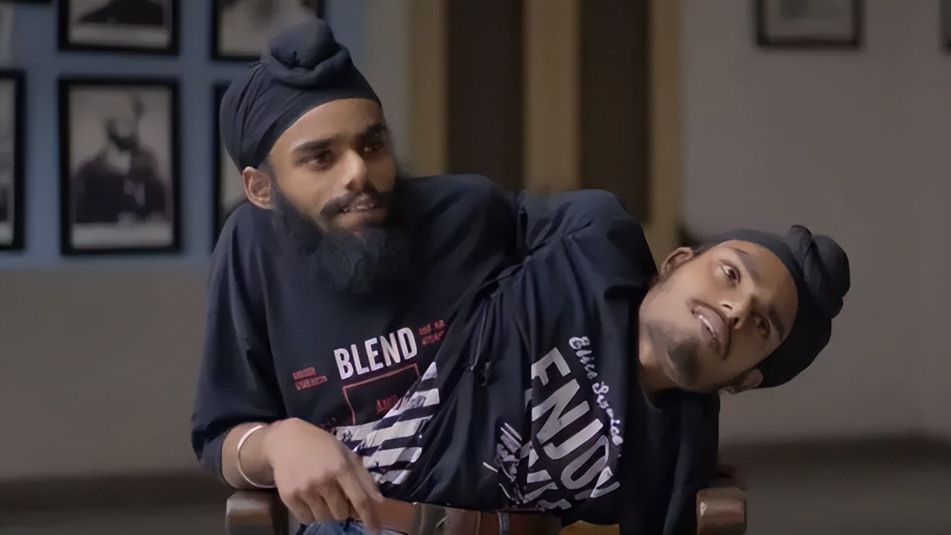 印度连体双胞胎兄弟,印度连体姐妹同嫁一个男人