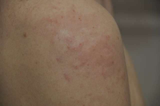 湿疹湿疮的区别,湿疹湿疮的中医治疗