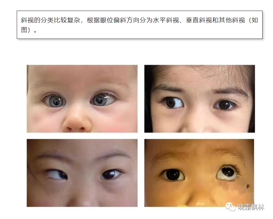 斜视一定要手术吗有保守治疗吗,斜视都需要做手术吗