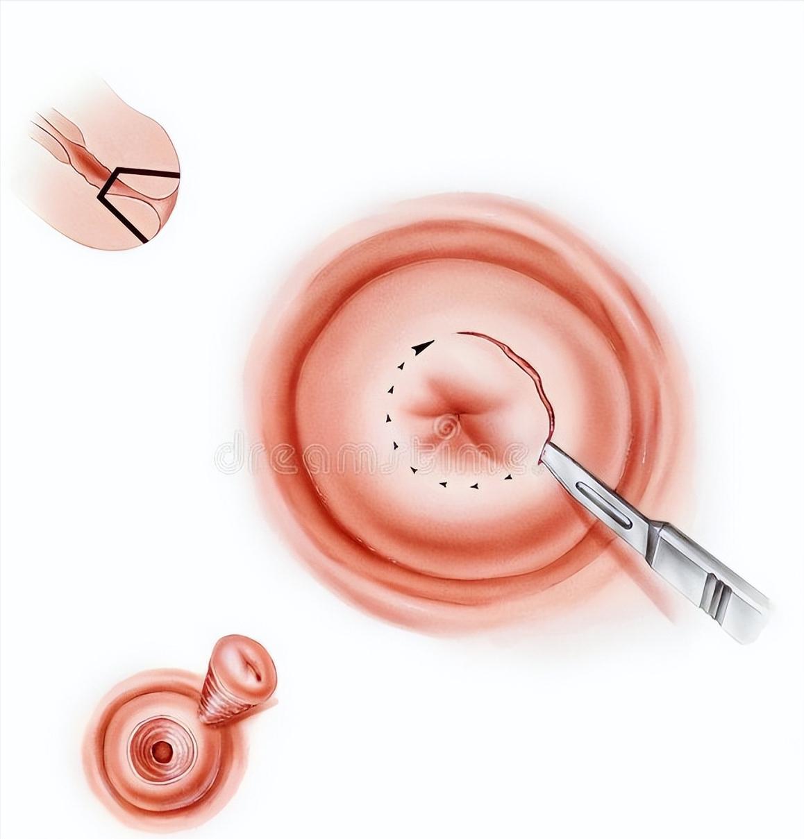 派特灵治疗宫颈病变效果怎么样,派特灵能治宫颈病变吗