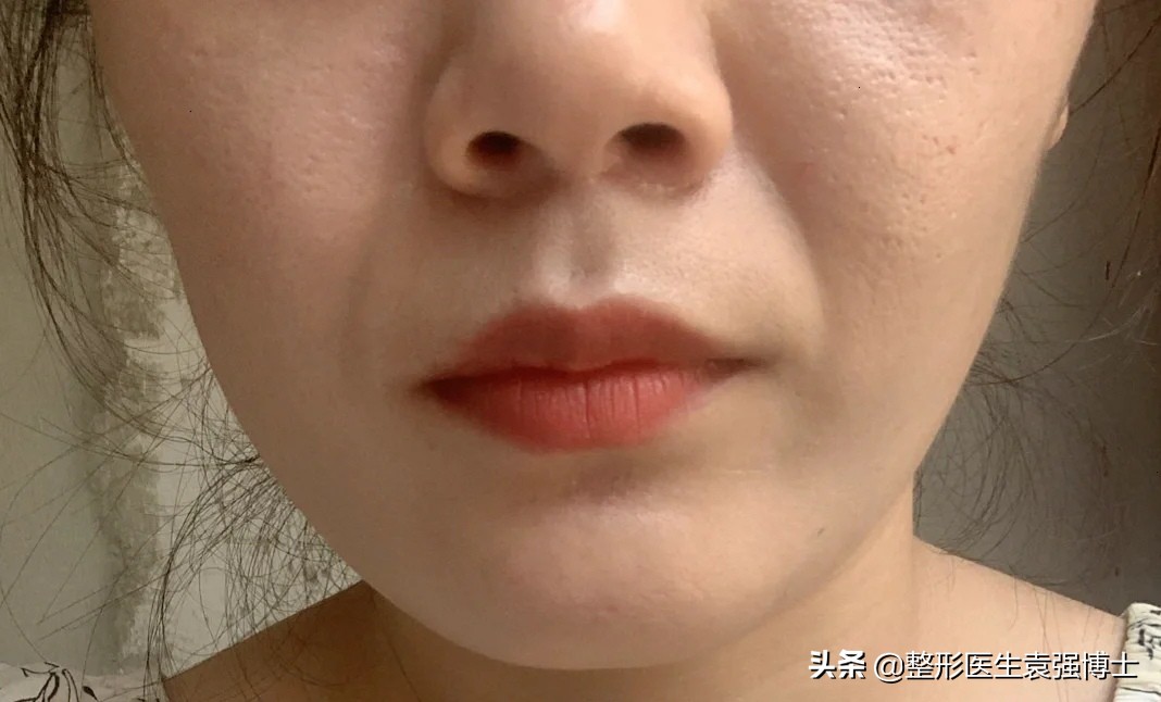 30多岁为什么法令纹那么严重,30岁左右法令纹严重怎么办