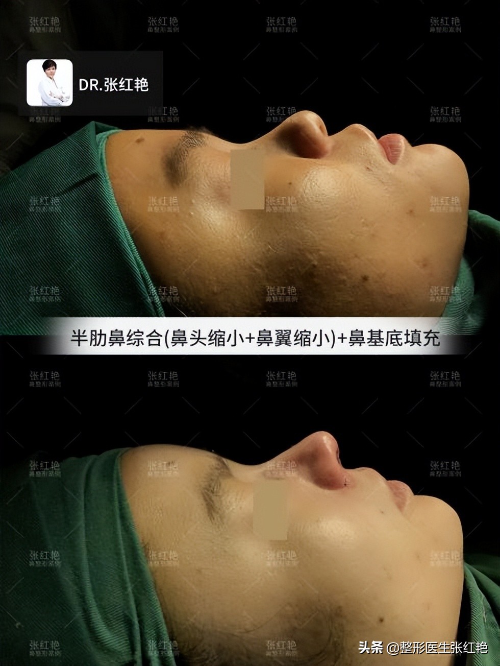 缩鼻翼怎么不留疤,缩鼻翼疤痕凸起