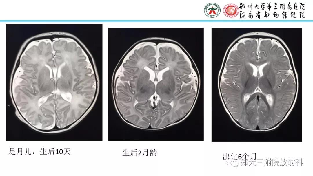 透明隔腔主要是判断什么,透明隔腔宽约10mm什么意思