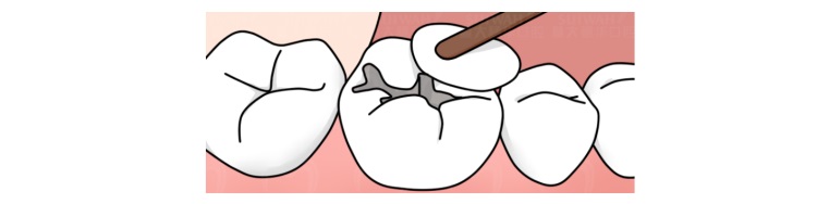 牙齿真的是被虫子吃掉的吗,牙齿是怎么进虫子的